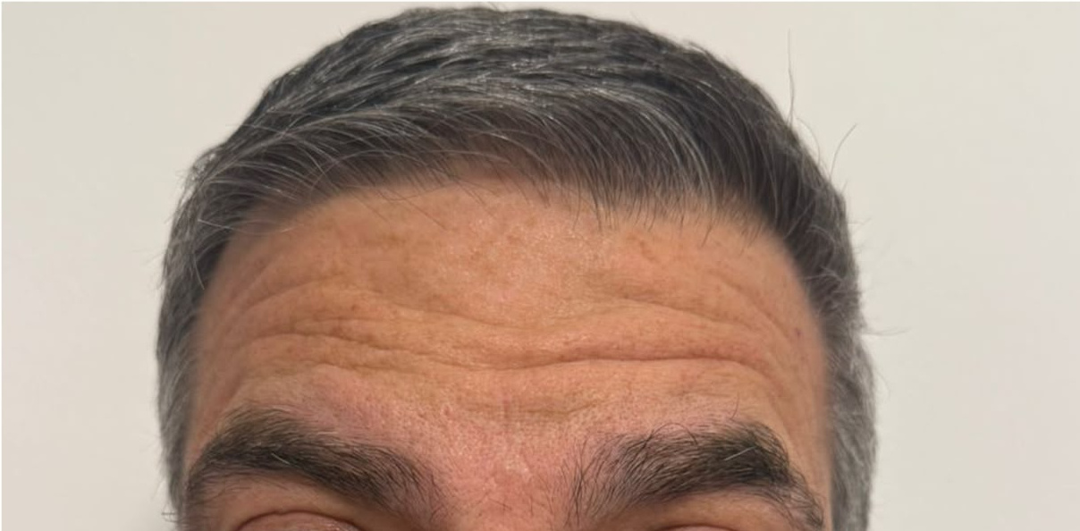 Antes